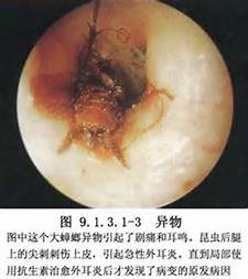 外耳道异物的内窥镜检查图
