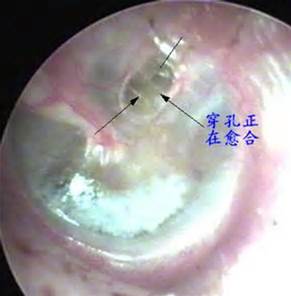 鼓膜穿孔正在愈合