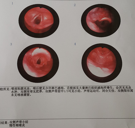 声带小结的症状检查结果