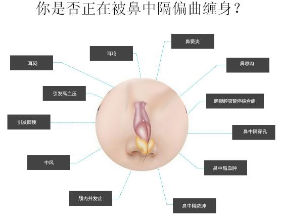 鼻中隔偏曲的危害