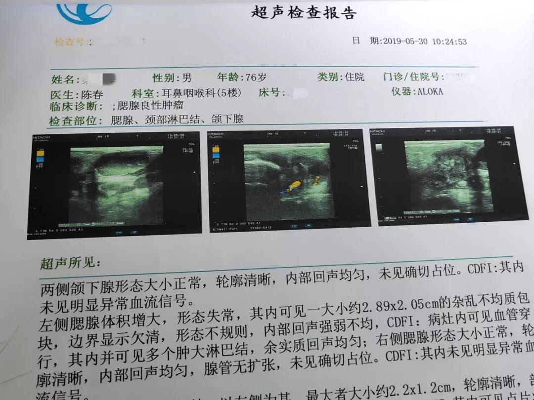 腮腺良性肿瘤