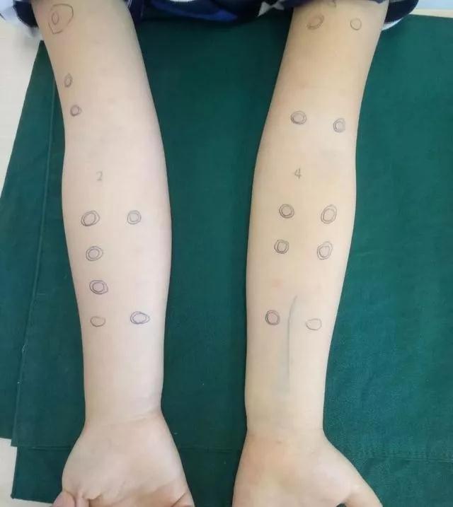 过敏