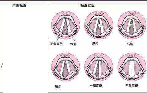 声带小结解剖图