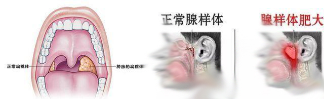 小儿腺样体肥大的五大危害?