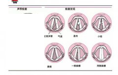 成都仁品治疗声带小结J1S怎么样？