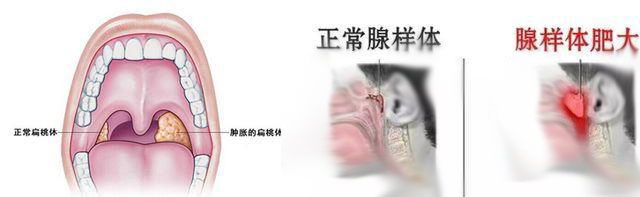 成都腺样体肥大的主要原因是什么?