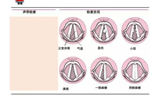 声带小结会引发哪些危害?
