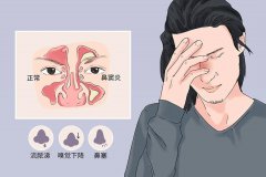 颌窦炎的病因是什么?成都仁品耳鼻喉医院解答