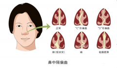 鼻中隔偏曲的典型症状及并发症！成都仁品耳鼻喉医院解答
