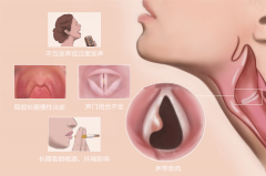 声带息肉久治不愈的原因有哪些？成都仁品耳鼻喉医院分析