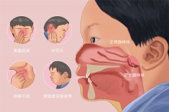 治疗腺样体肥大必须要手术吗？成都耳鼻喉医院解答