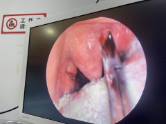 怀疑鱼刺卡到食道怎么办？成都仁品卡鱼刺便民门诊_医生24小时值班